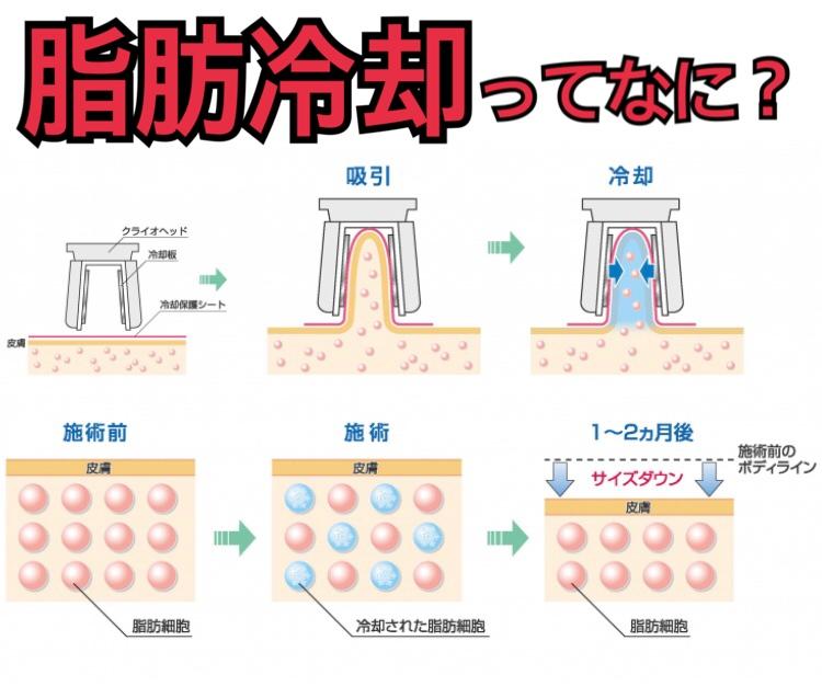 脂肪冷却 脂肪冷却痩身